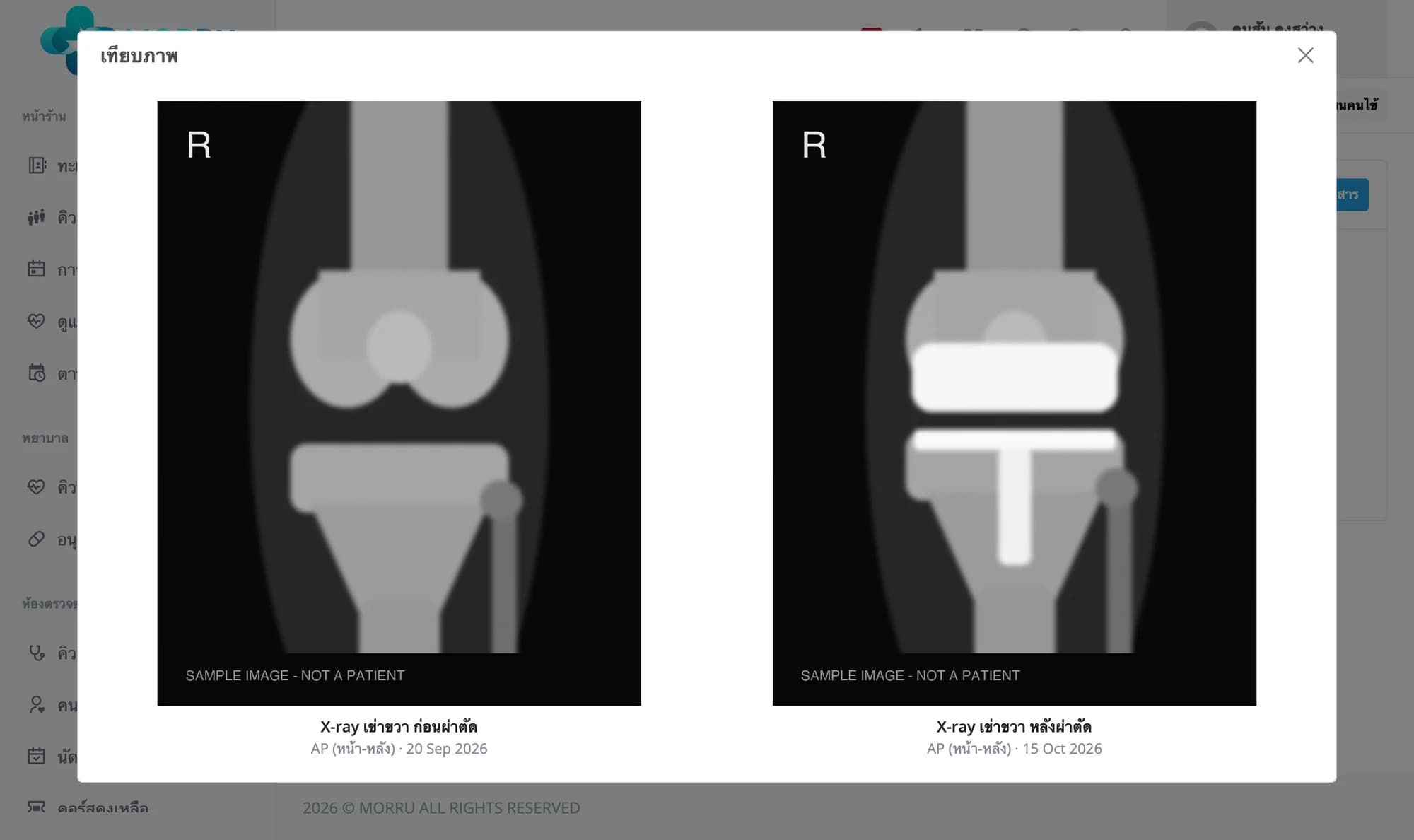 กล่องเทียบภาพ X-ray เข่าขวาก่อนผ่าตัดด้านซ้าย หลังผ่าตัดด้านขวา ใต้ภาพบอกชนิดภาพและวันที่