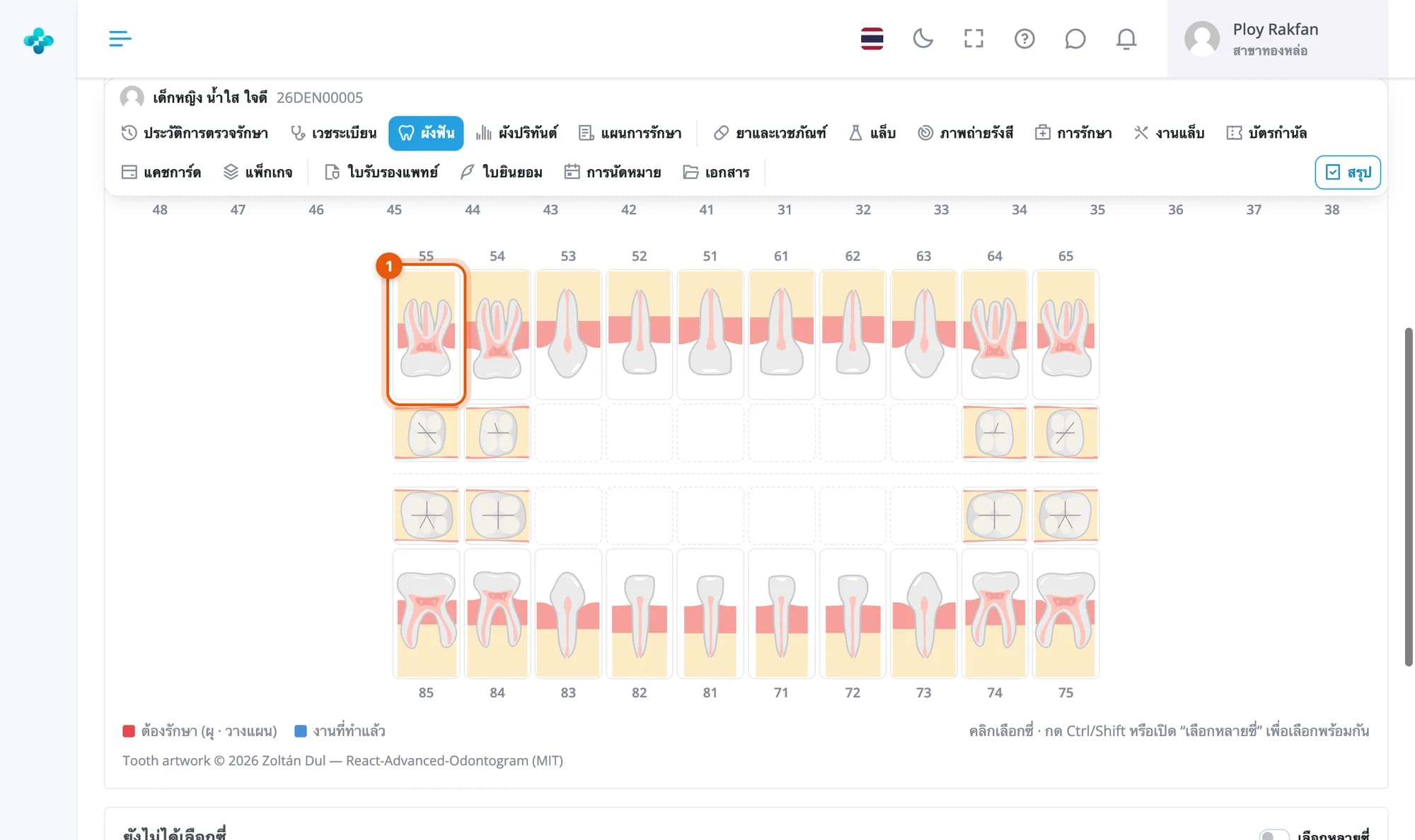 ผังฟันชุดผสมของเด็กหญิง น้ำใส ใจดี แถวฟันน้ำนม 55 ถึง 65 และ 85 ถึง 75 วงที่ซี่ 55